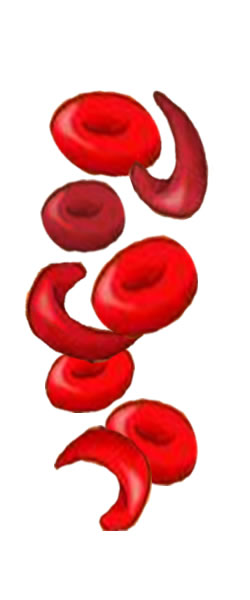 SickleCell_NormalCell